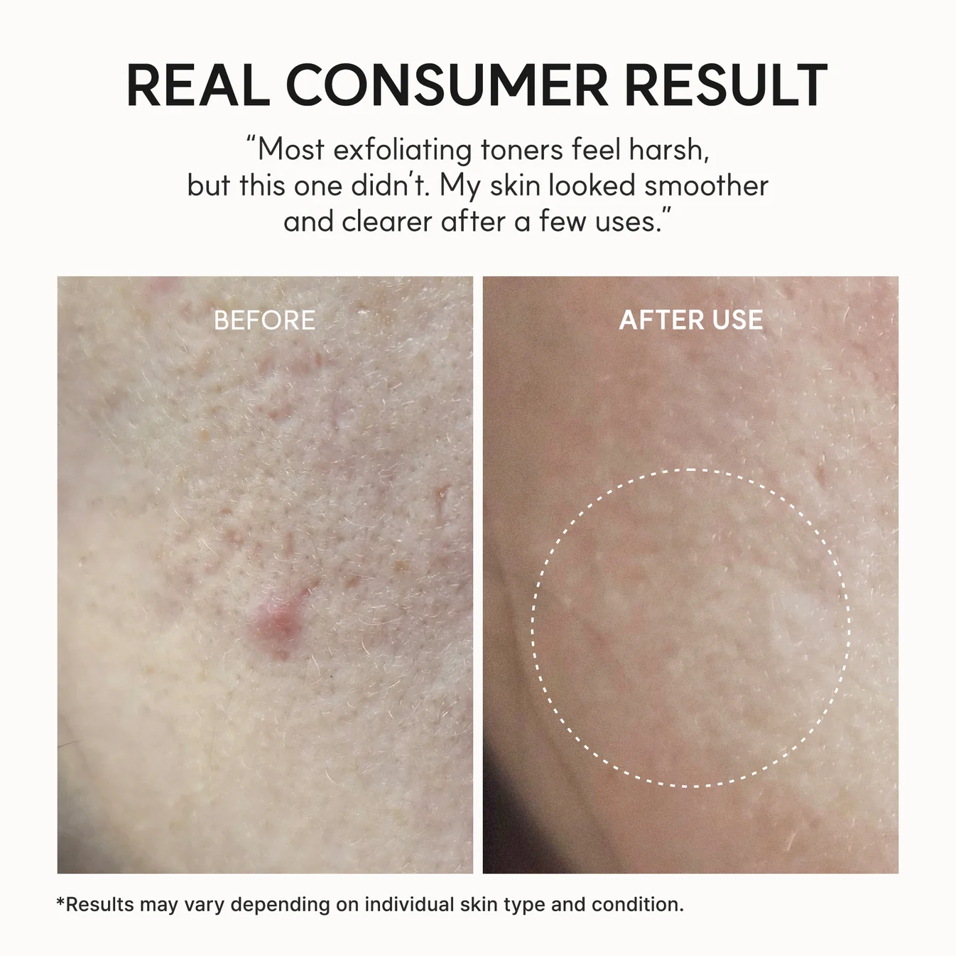  تونر لایه‌بردار و روشن کننده گلیکولیک اسید آریسیا اریزر شات Arencia Eraser Shot Glycolic Acid Exfoliator 