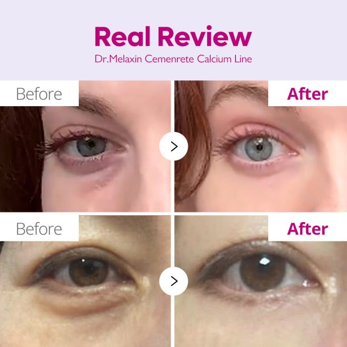  کرم دور چشم کلسیم دارک اسپات دکتر ملاکسین ضد چروک و روشن کننده قوی Dr. Melaxin Cemenrete Calcium Dark Spot Correcting Ey 